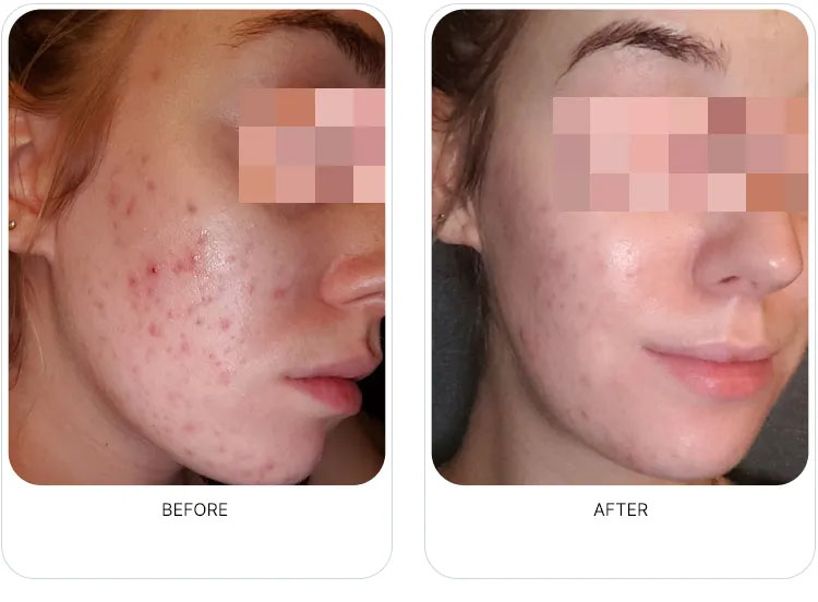 Acne improvement image